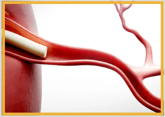 Catheter Engagement